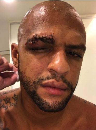 chấn thương của Felipe Melo ảnh 1 chan thuong cua Felipe Melo anh 1