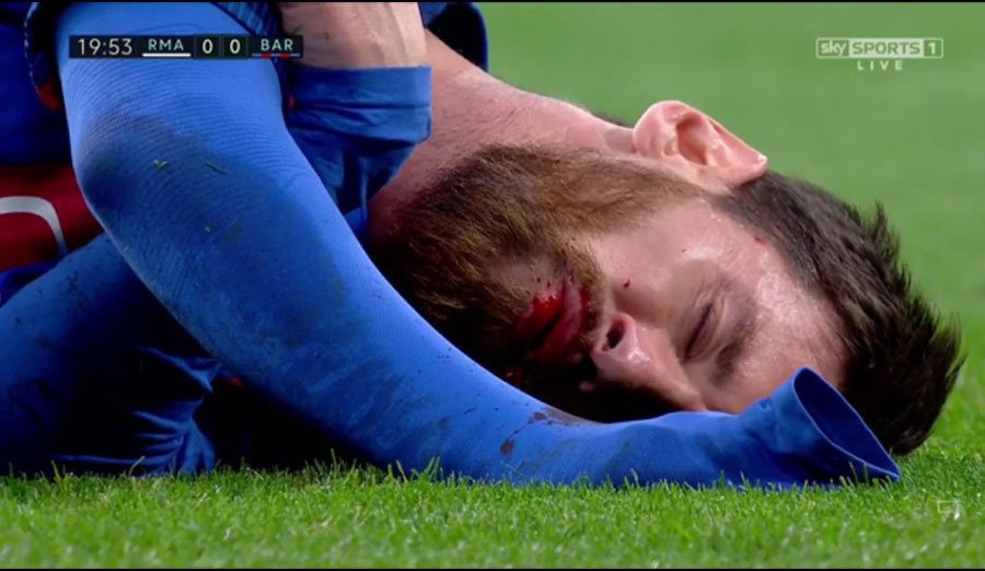 Messi nho ra chiec rang bi gay hinh anh