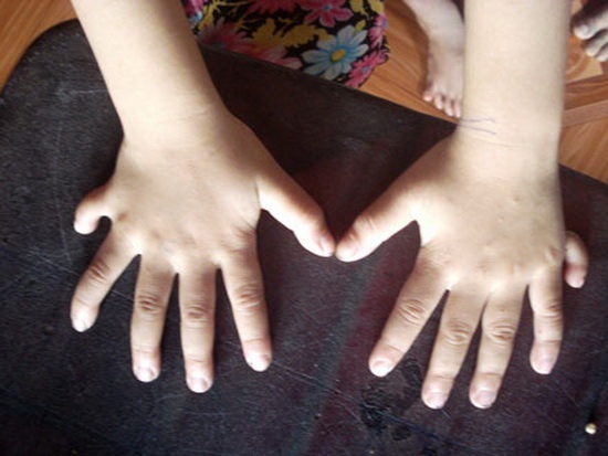 thủ môn 6 ngón ảnh 3 thu mon 6 ngon anh 3