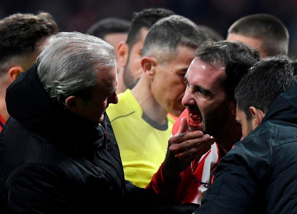 Diego Godin gãy răng ảnh 5 Diego Godin gay rang anh 5