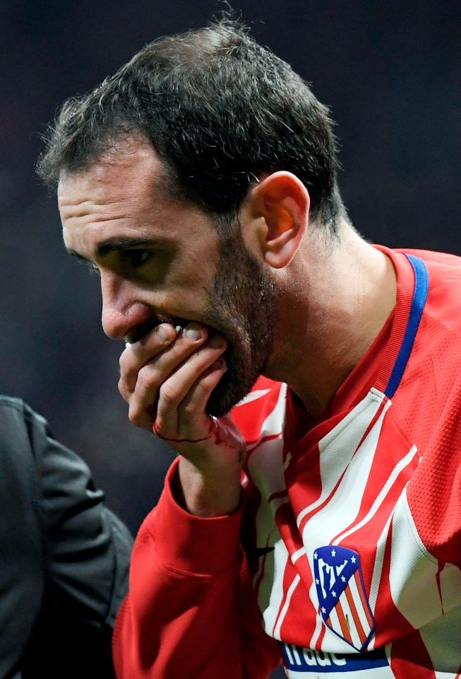 Diego Godin gãy răng ảnh 4 Diego Godin gay rang anh 4