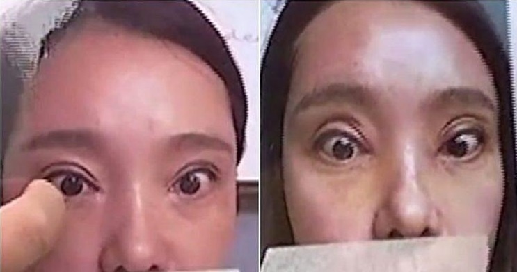 Khong the nham mat, thi luc giam sut sau 2 lan cat mi mat 2.100 USD hinh anh