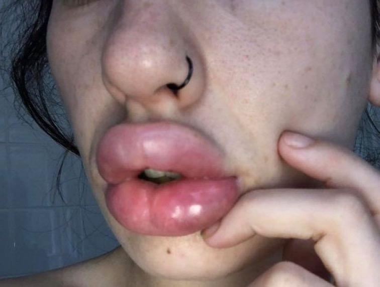 Moi 9X sung phong, bi seo vinh vien vi tiem filler gia re hinh anh