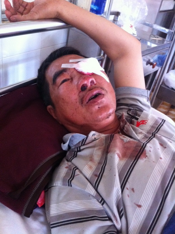 Ông Trương Triệu Lương bị các đối tượng ném đá xe khách gây chấn thương.