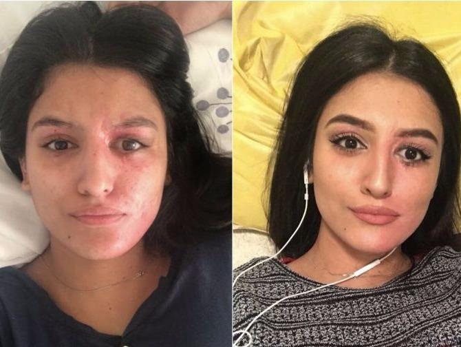 Khong muon 'song ao', nguoi mau dang anh mat bien dang vi axit hinh anh