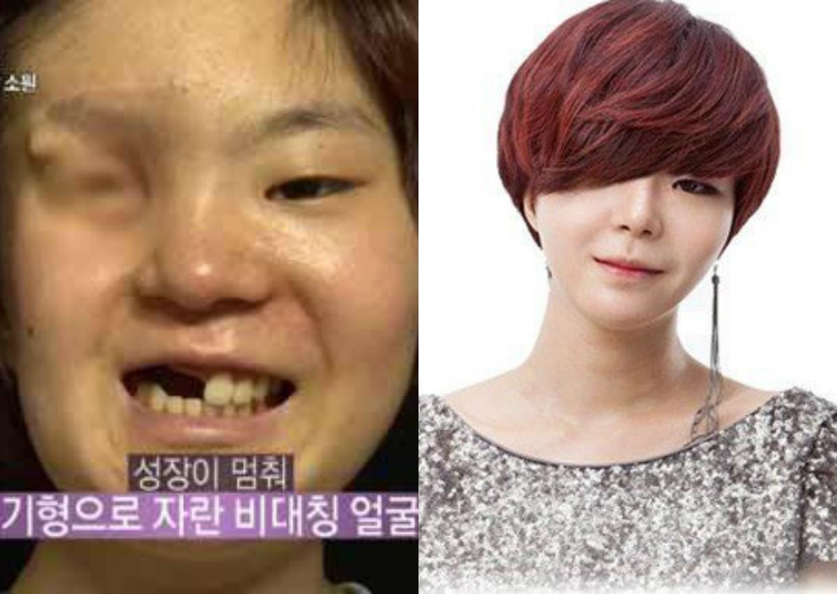 giới trẻ phẫu thuật thẩm mỹ ảnh 3 gioi tre phau thuat tham my anh 3