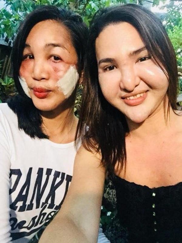 giới trẻ phẫu thuật thẩm mỹ ảnh 5 gioi tre phau thuat tham my anh 5