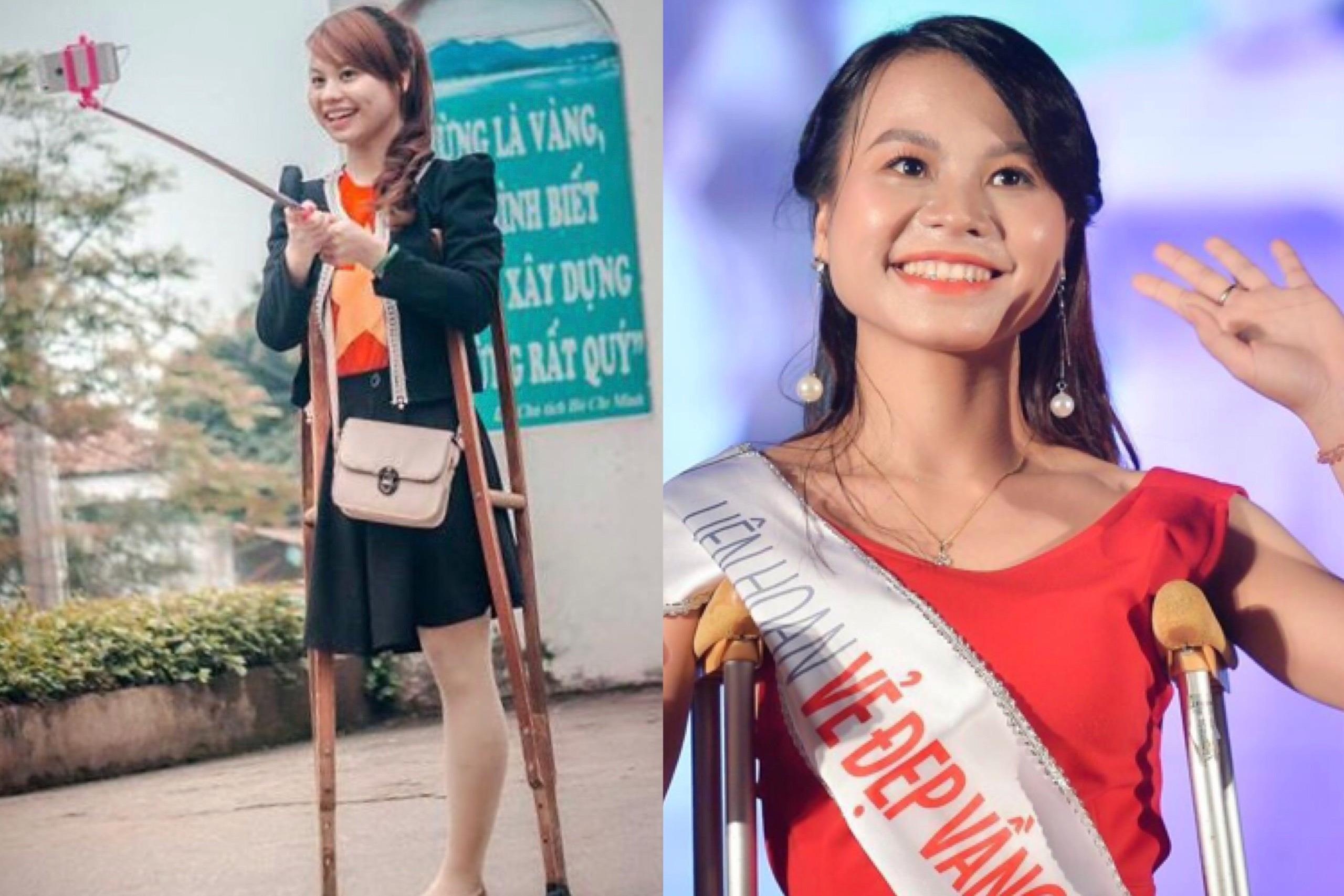 Co gai mat mot chan, noi tieng voi buc anh selfie nam 2016 gio ra sao hinh anh