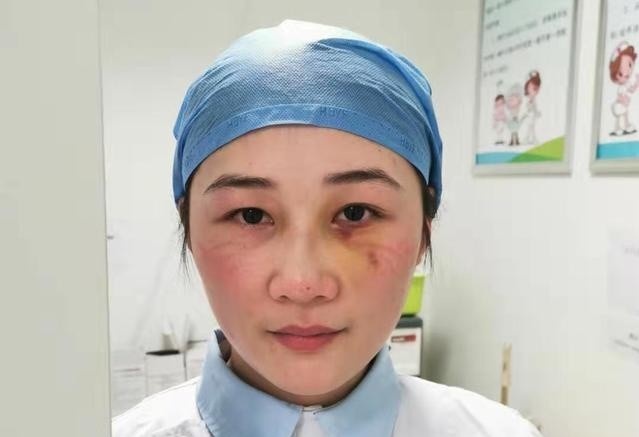 Lam viec ngat xiu, gay xuong mui, y ta o Vu Han chi dam nghi 1 ngay hinh anh