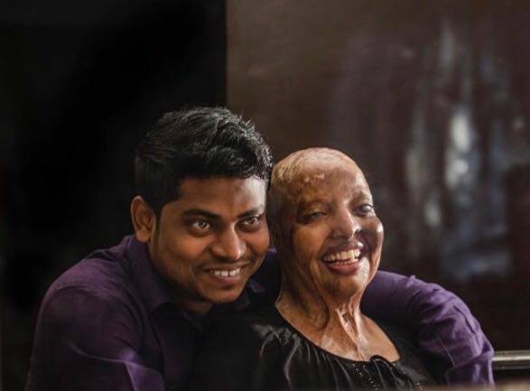 co gai An Do bi tat axit nam 15 tuoi anh 6