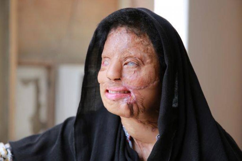 co gai bi tan cong axit thang Ai la trieu phu anh 4