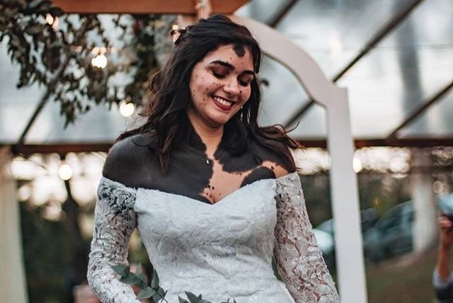 Co gai bi bot che kin 80% co the van co tinh yeu dep hinh anh