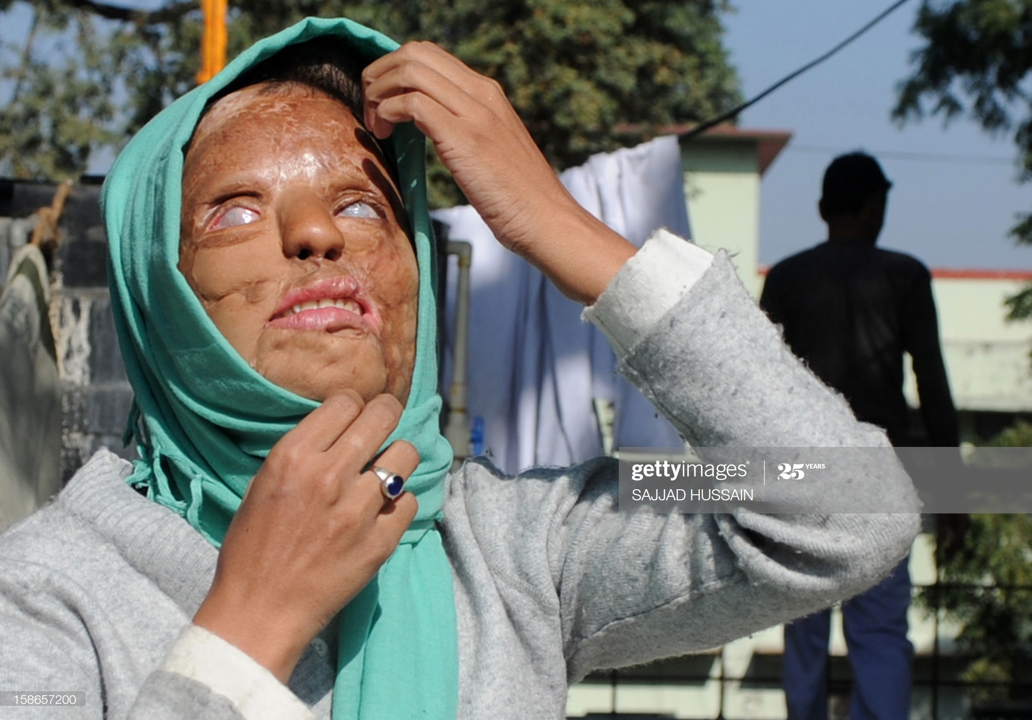 co gai bi tan cong axit thang Ai la trieu phu anh 5