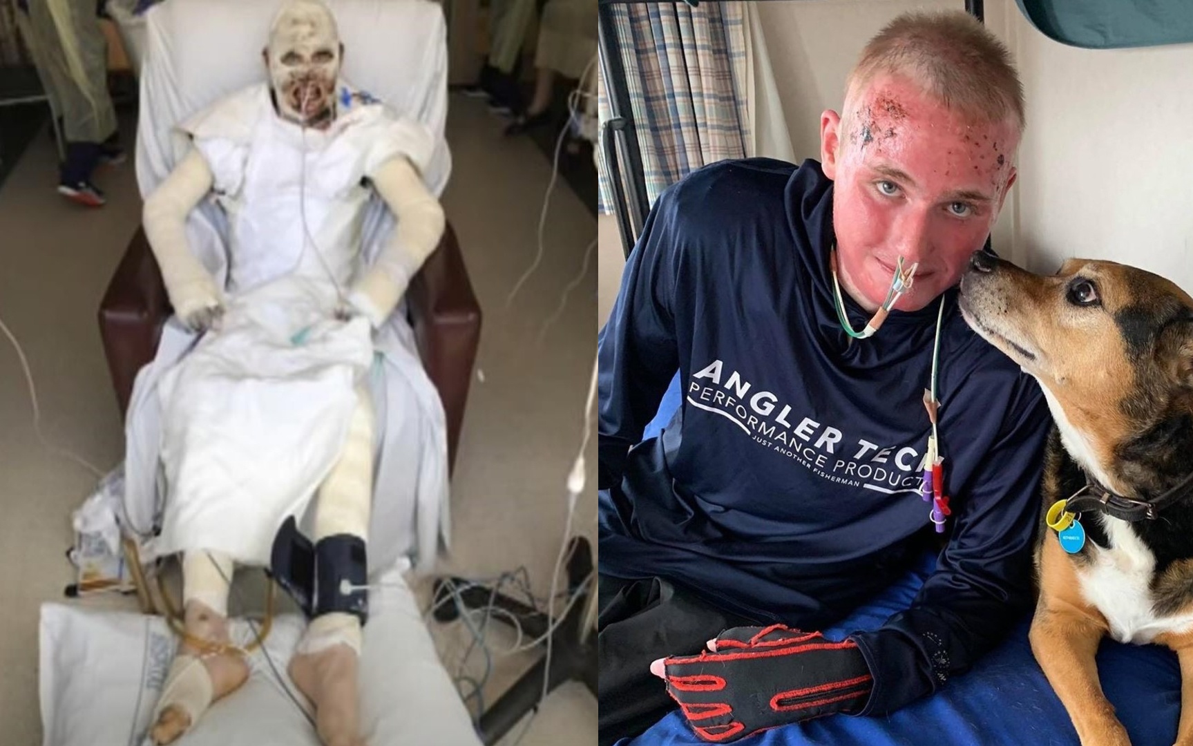 Chang trai song sot sau vu nui lua phun trao, bong 80% co the hinh anh