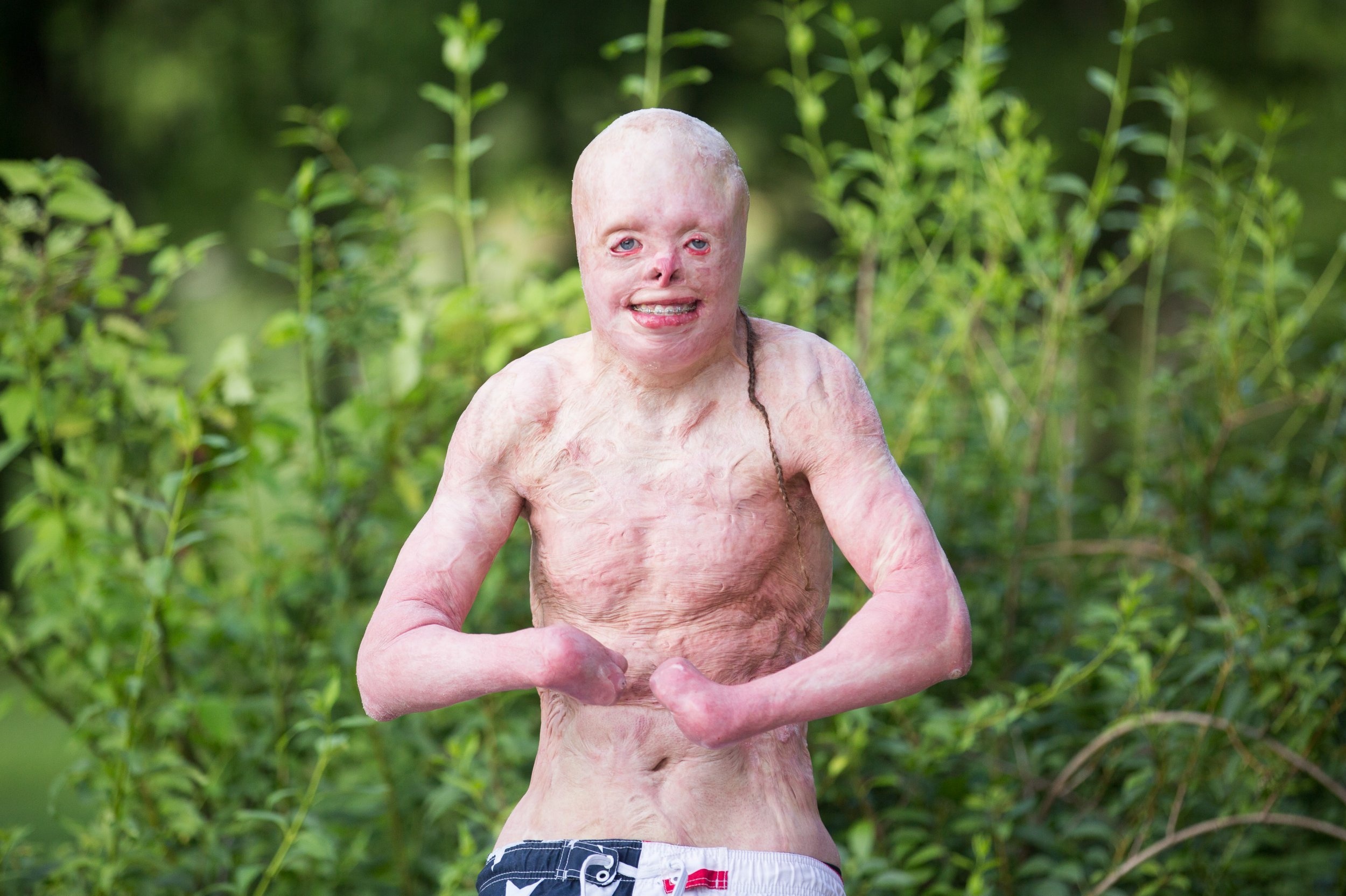 Nghi luc cua chang trai bong 95% co the, tung coi minh la quai vat hinh anh