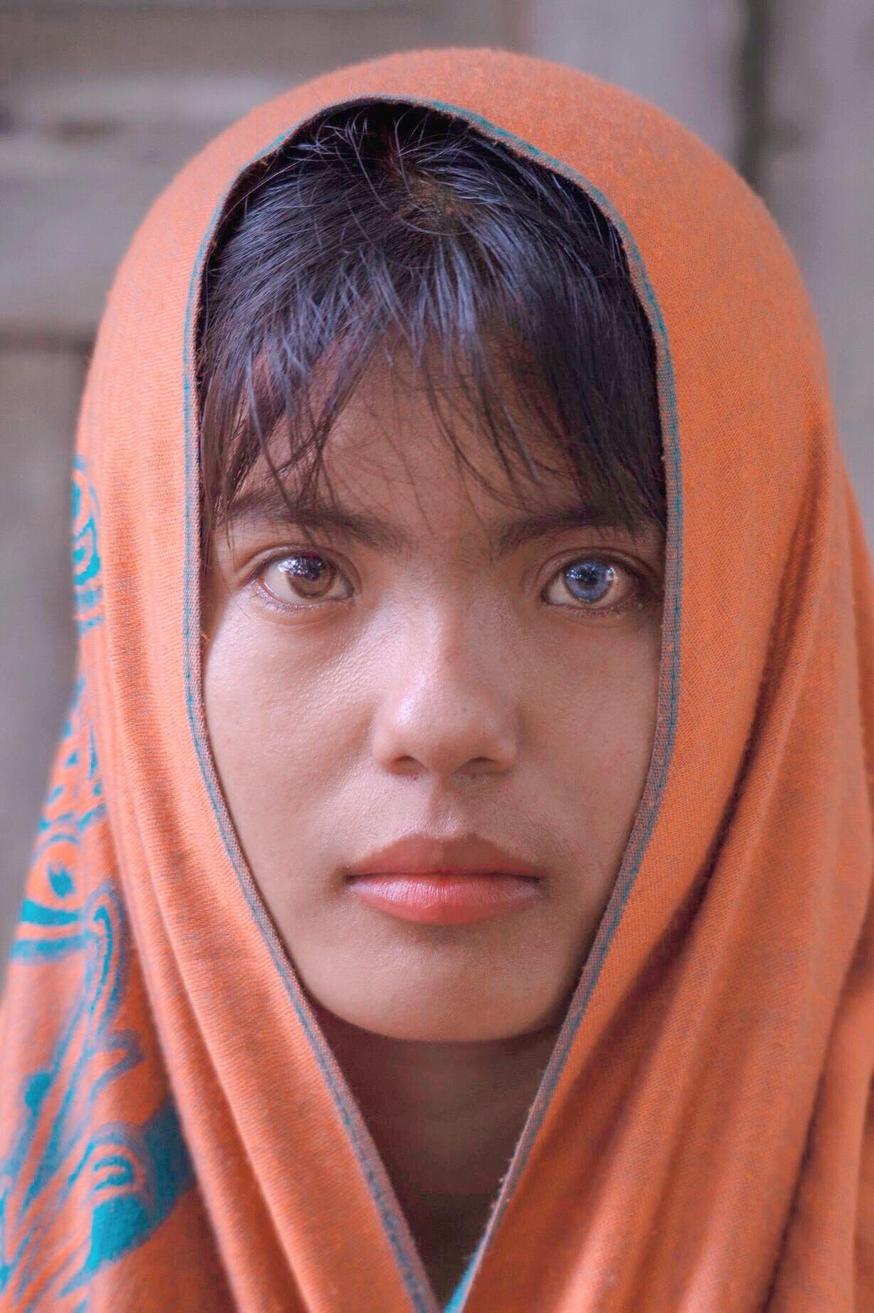 co gai Cham co 2 mau mat anh 3