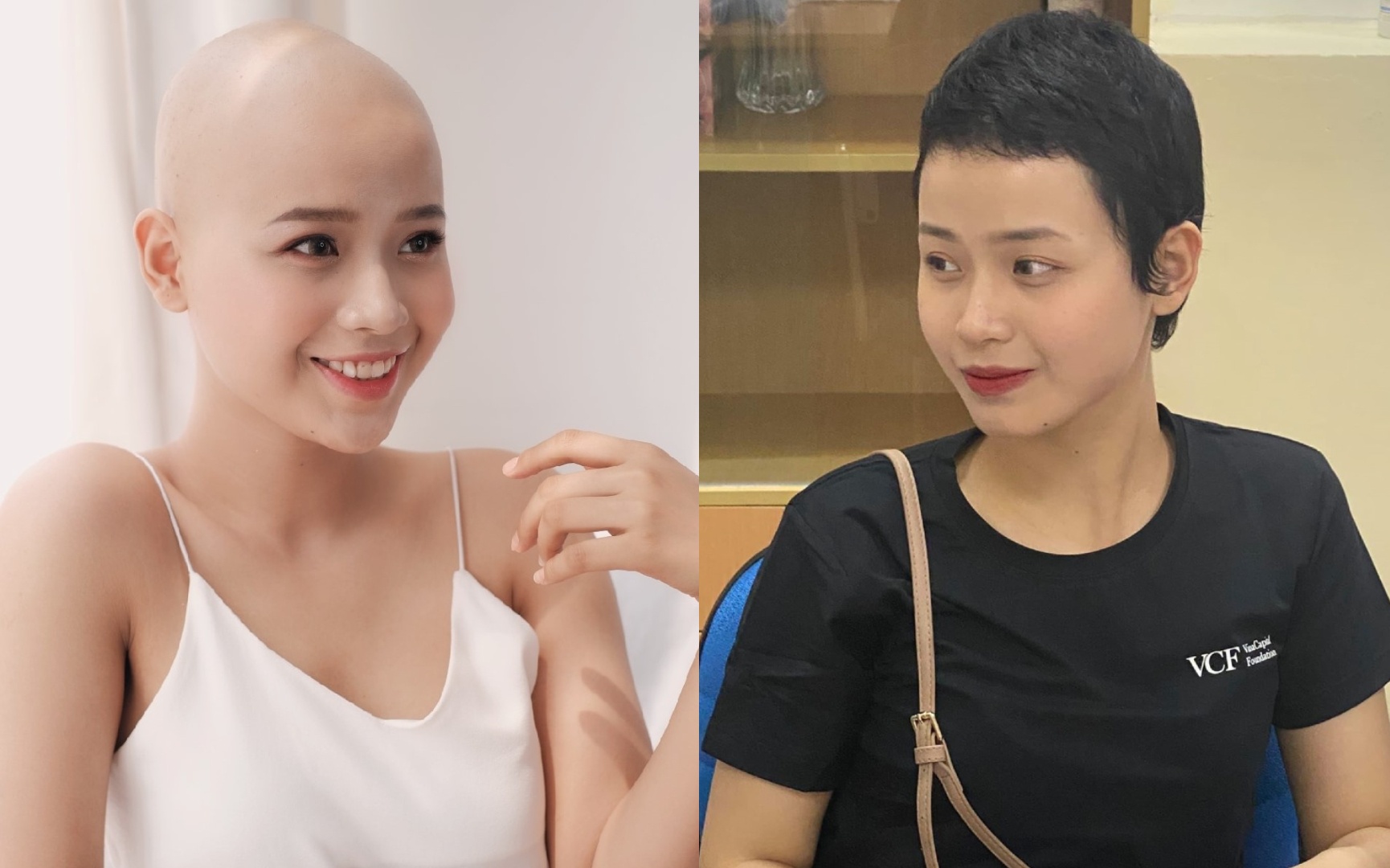 Nu sinh Ngoai thuong mac ung thu da moc lai toc, co the duoc ra vien hinh anh