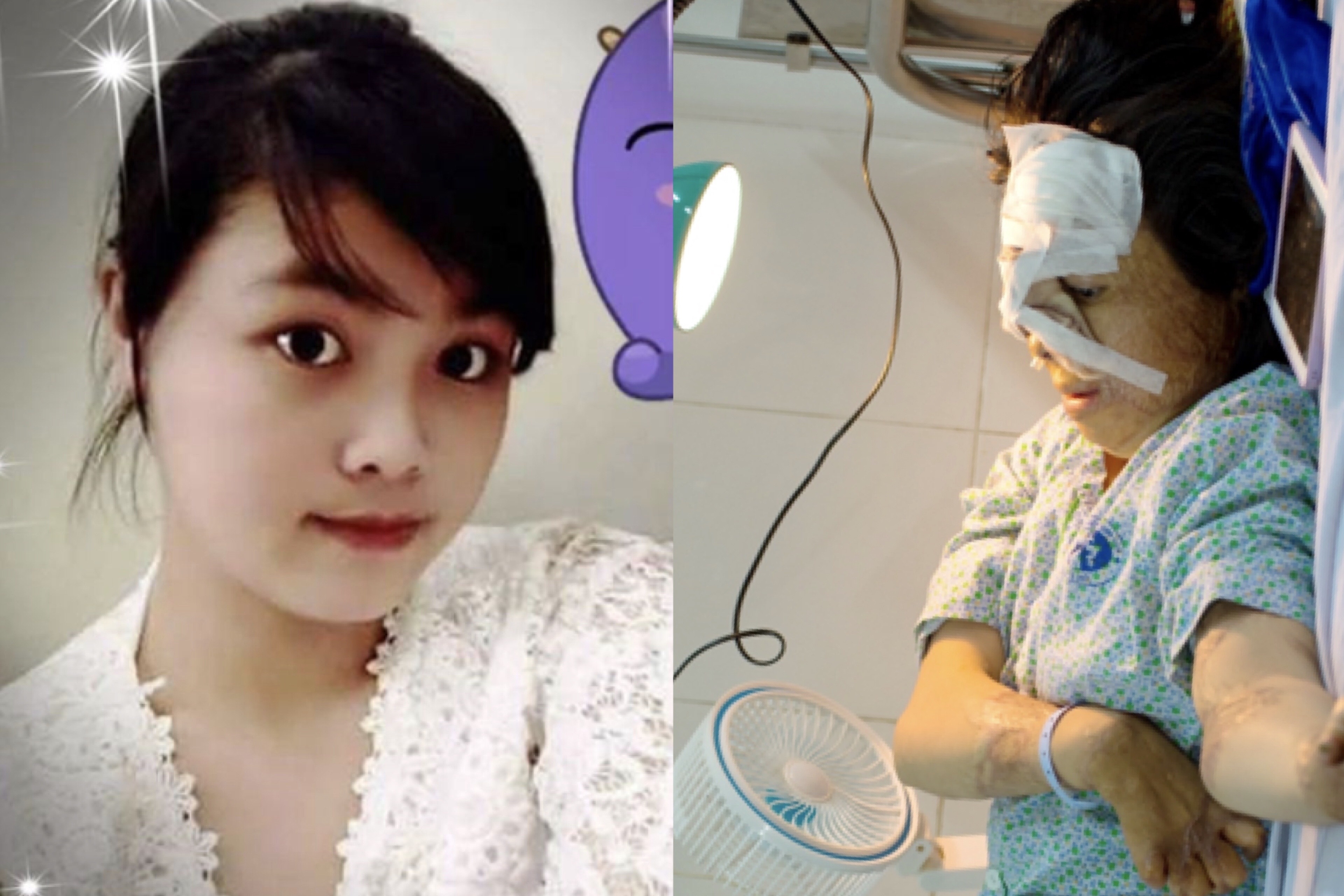 Lan phau thuat thu 17 cua co gai bi chong tuoi xang thieu song hinh anh