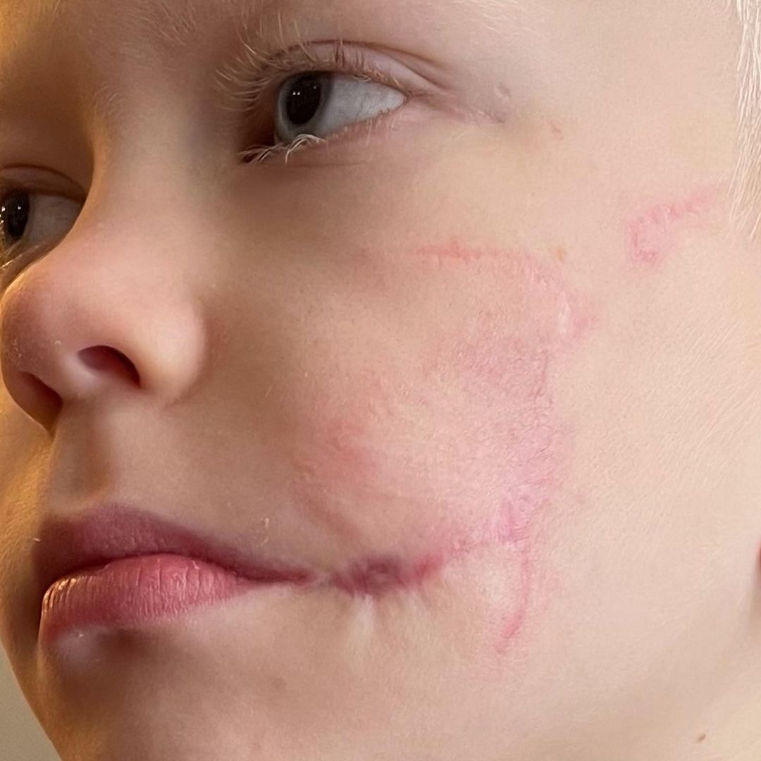 Cau be khau 90 mui vi cuu em gai duoc chua seo mien phi anh 2