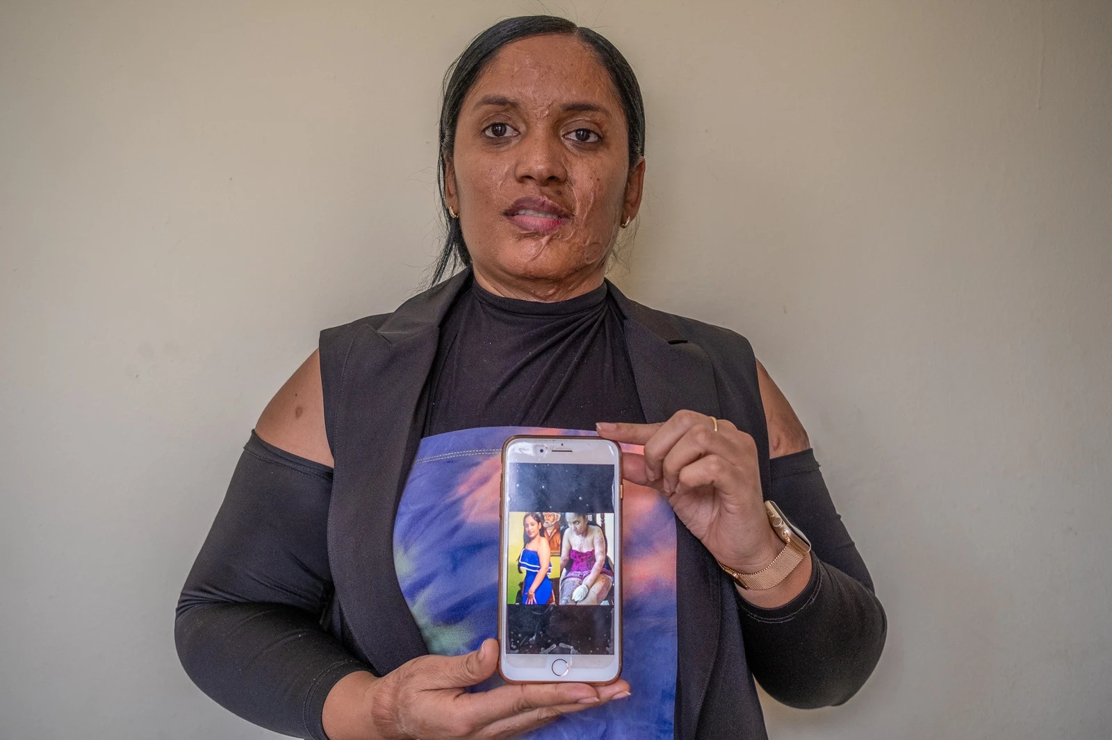 nguoi phu nu giup nan nhan bi tat axit qua anh selfie anh 4