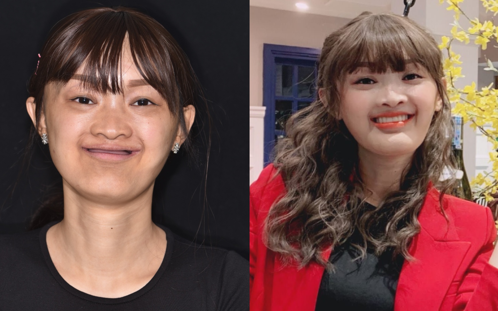 Hanh trinh di tim nu cuoi cua co gai khong rang, khong toc bam sinh hinh anh