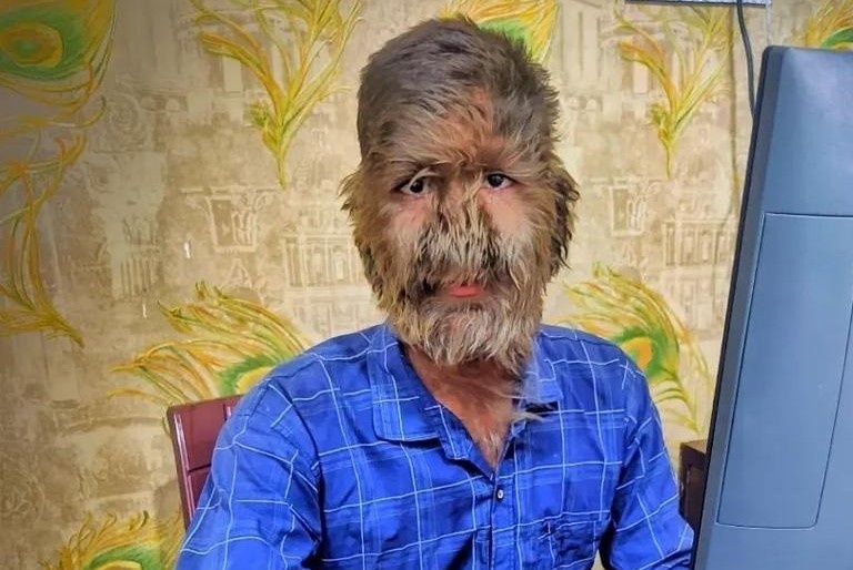 Cuoc song cua chang trai mac chung ‘nguoi soi’ hinh anh