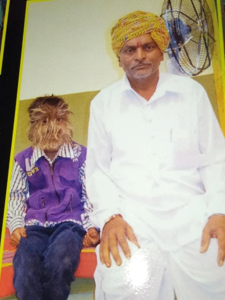 Benh nguoi soi anh 1