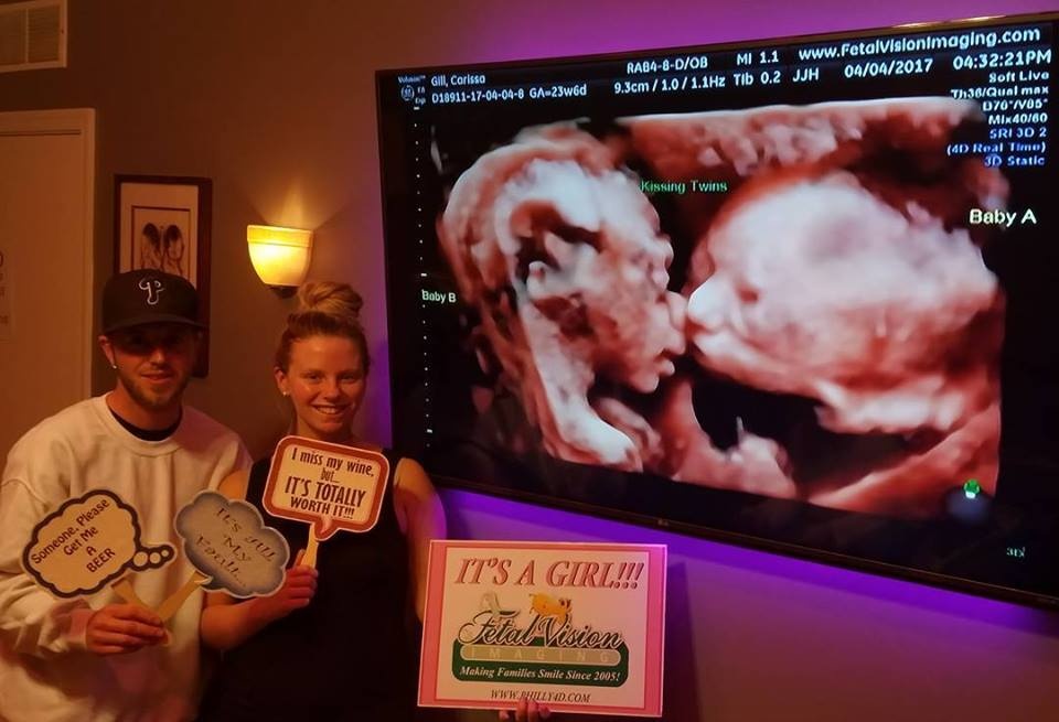 Cap song sinh hon nhau trong bung me hinh anh