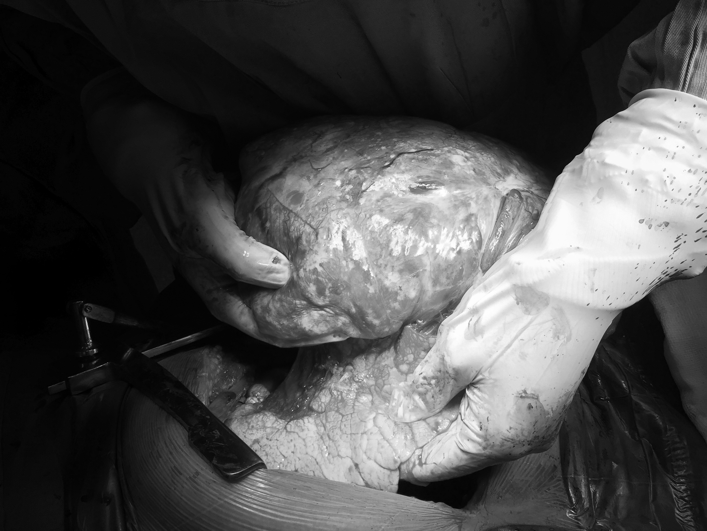 Khoi u 2, 6 kg de xep phoi trai benh nhan anh 2