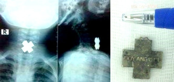 Bé trai 3 tuổi nuốt mặt dây chuyền chữ thập ảnh 1 Be trai 3 tuoi nuot mat day chuyen chu thap anh 1
