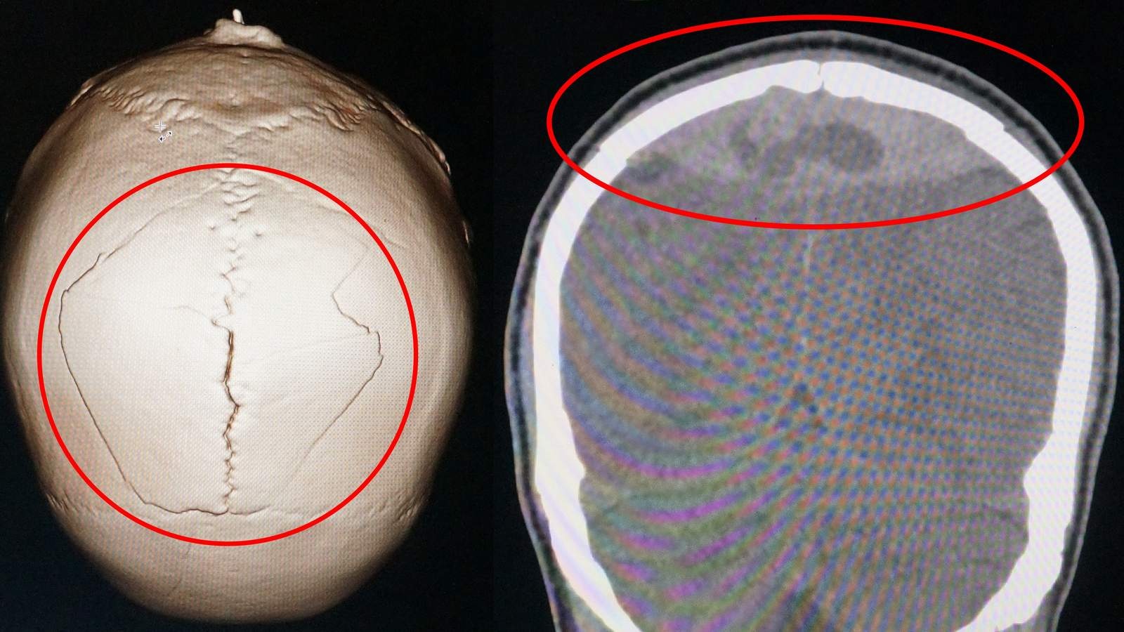 Benh nhan nut so, tu mau nao 2 ngay ma khong hay biet hinh anh