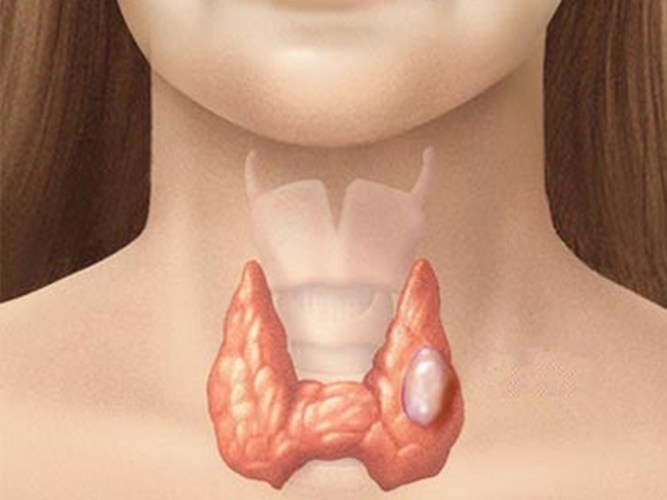 Bien phap dieu tri buou co khong can phau thuat hinh anh