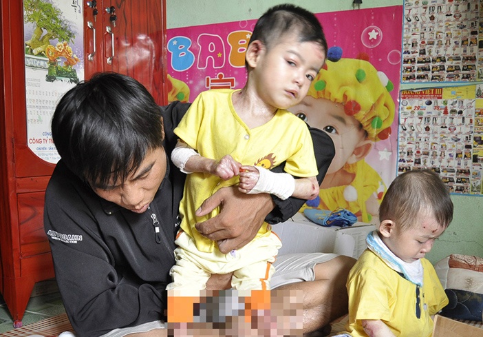 Hai be rung ngon chan, ngon tay vi mac benh quai ac hinh anh