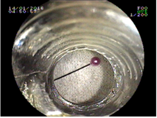 Phau thuat gap kim theu tranh trong bung be gai hinh anh