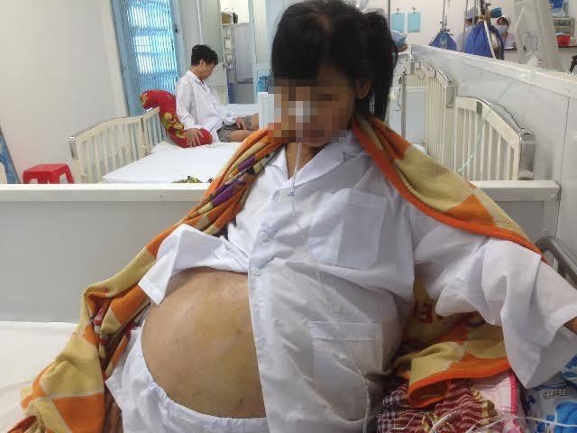Benh nhan mang khoi u buong trung nang 32 kg hinh anh