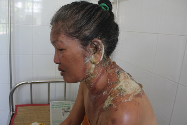 Chong do ca binh nuoc soi vao tai vo noi tieng bao hanh hinh anh