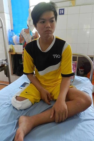 bệnh nhân cắt cụt chân ảnh 1 benh nhan cat cut chan anh 1