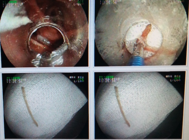 Hóc xương vịt ảnh 1 Hoc xuong vit anh 1