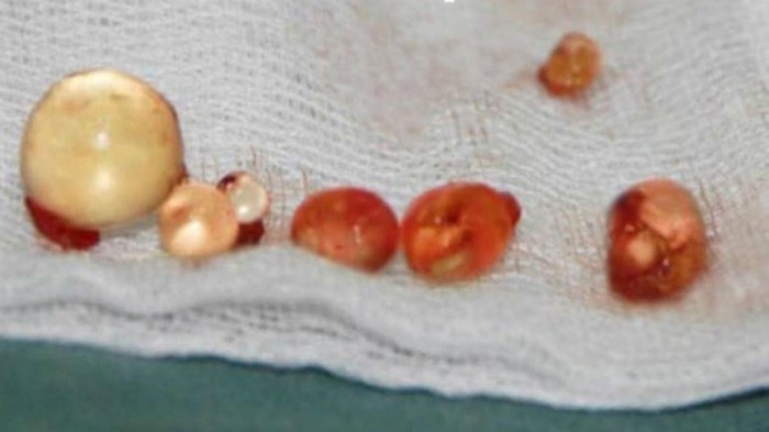 Suyt hong 'sung' vi bom silicon de tang kich co hinh anh