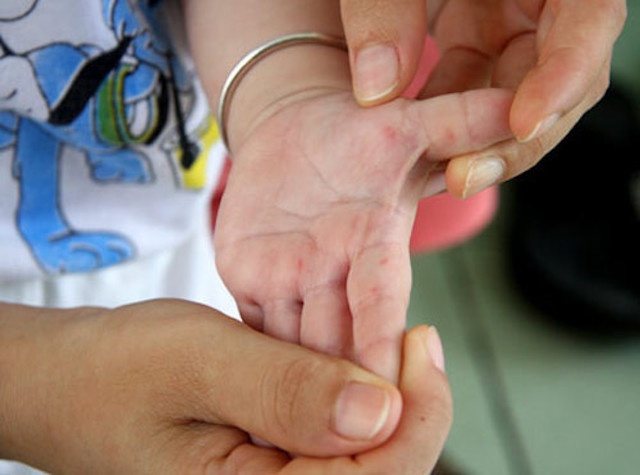 Be gai 2 tuoi tu vong sau 3 ngay mac benh tay chan mieng hinh anh