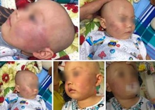 Be trai 19 thang tuoi bi bao mau tat sung mat hinh anh