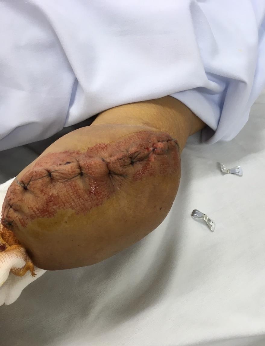 Người đàn ông đứt hai bàn tay ảnh 1 Nguoi dan ong dut hai ban tay anh 1