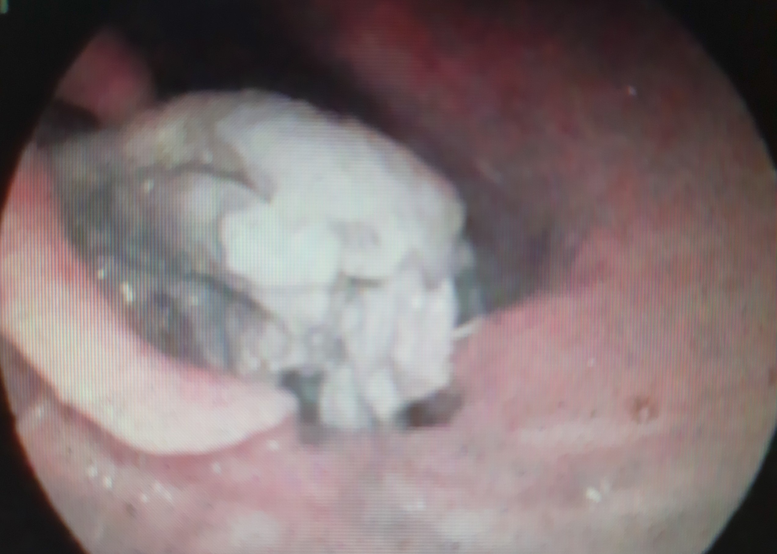 cấp cứu vì lỡ nuốt phao câu vịt xiêm ảnh 1 cap cuu vi lo nuot phao cau vit xiem anh 1