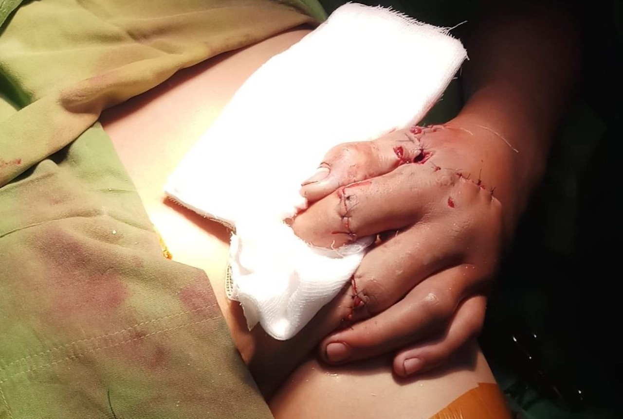 Nam thanh nien dap nat ban tay do phao no anh 1