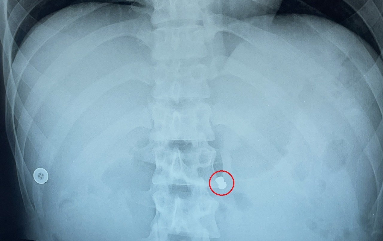 Nam thanh nien bi ban thung bung khi di trom cho hinh anh