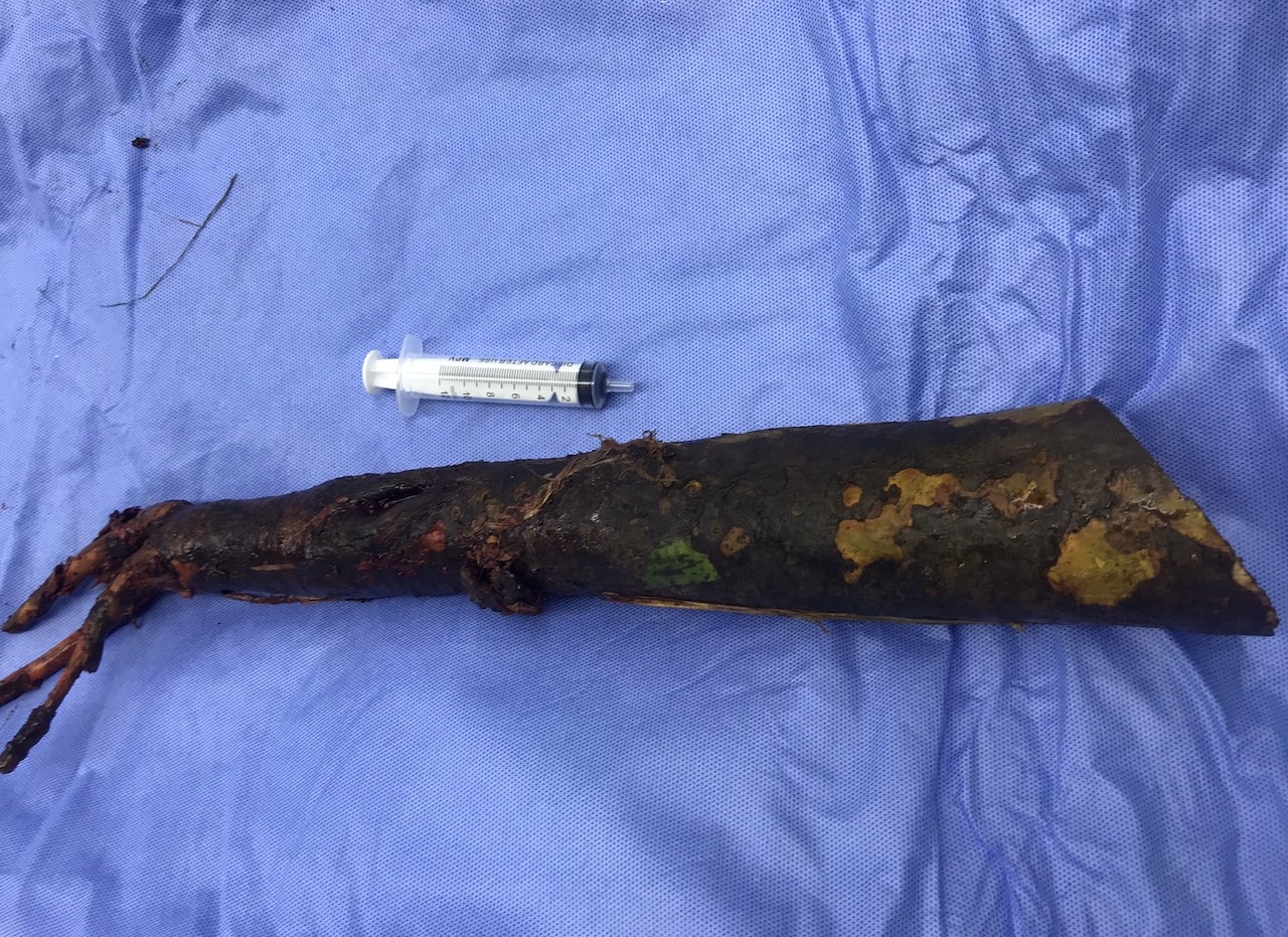 Nguoi dan ong bi coc dam xuyen nguoi hinh anh