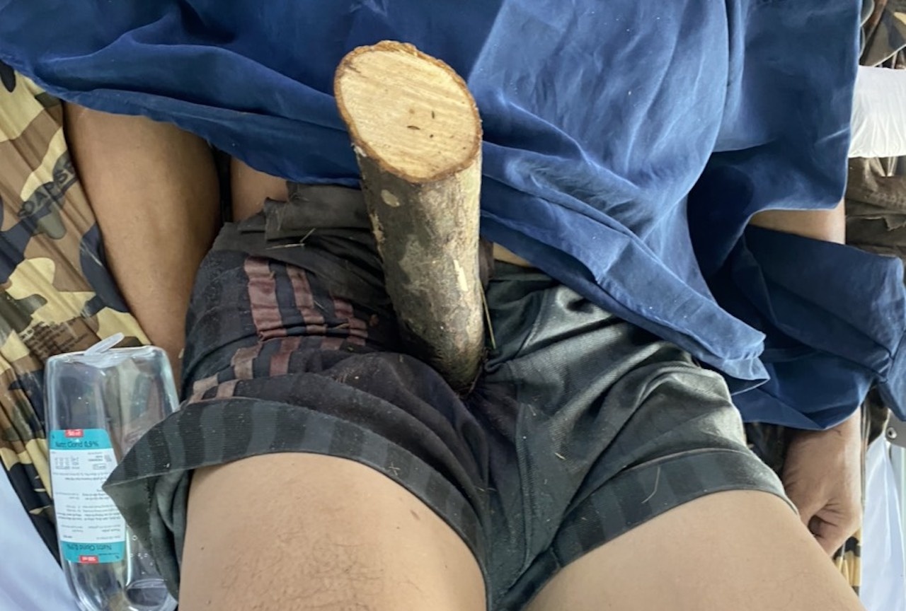 bi coc dam xuyen nguoi anh 2