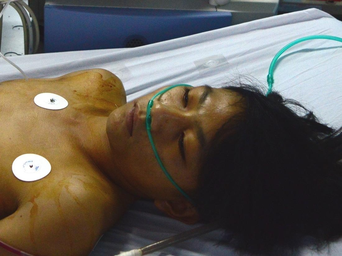 Nam 9X thoat chet hy huu sau cu dam xuyen tim hinh anh