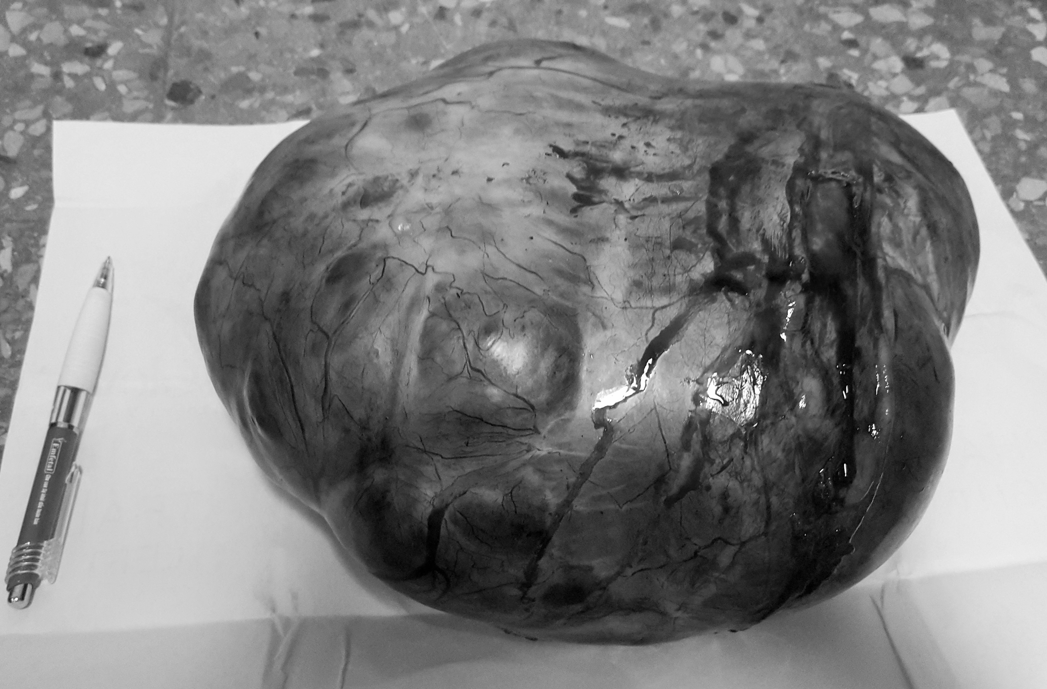 Cu ba 85 tuoi mang khoi u lon trong bung anh 1