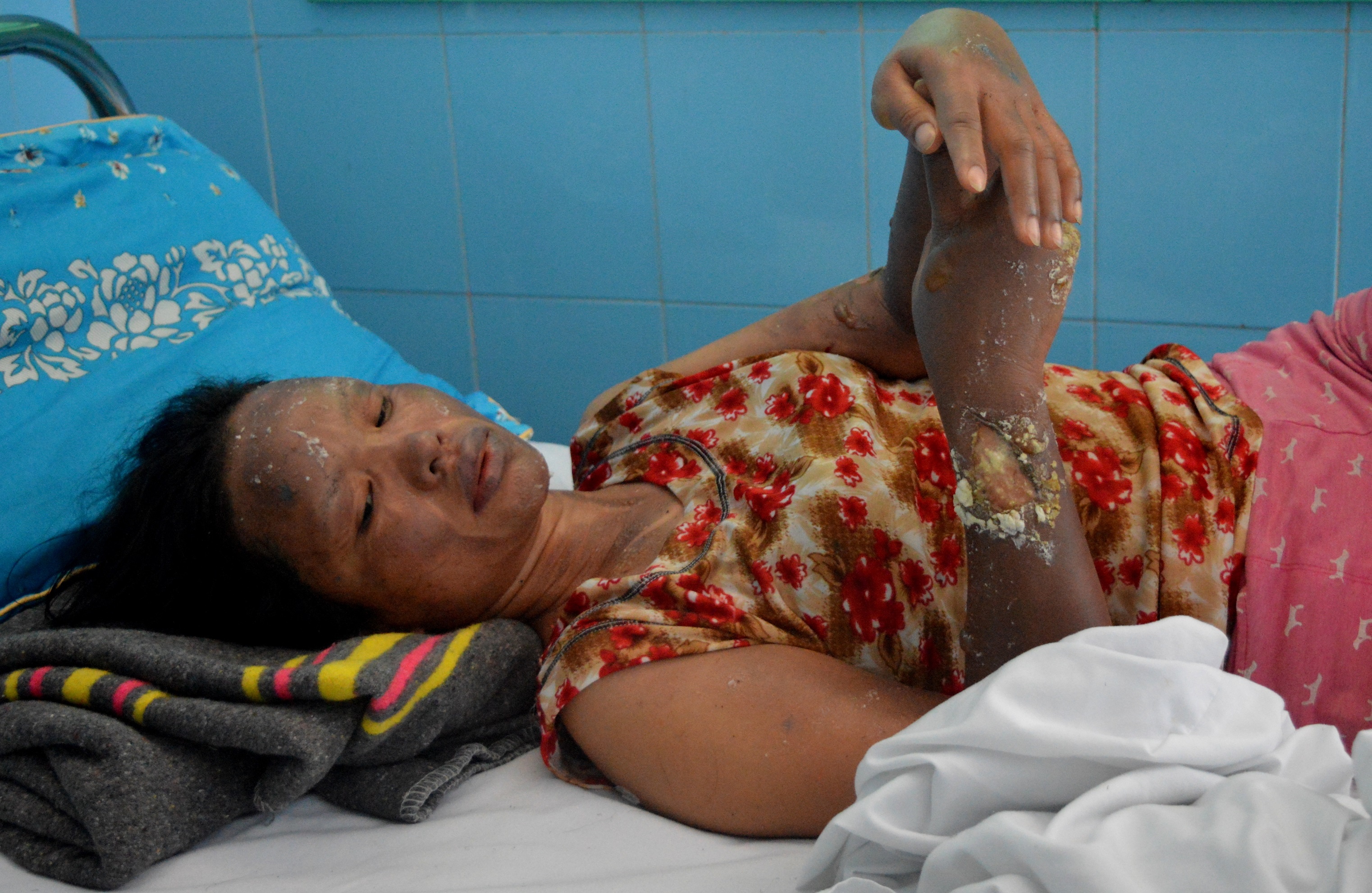 Phut hang chuc qua bong bay phat no khien nhieu nguoi nhap vien anh 1